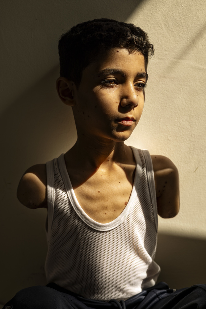 Mahmoud Ajour, 9 years old, lost both hands after being hit by a missile from Israeli warplanes during the war on Gaza, in Doha, Qatar, June 28, 2024.A portrait project on wounded Gazans in Doha. Story summary:Amputations. Disfiguration. Brain d